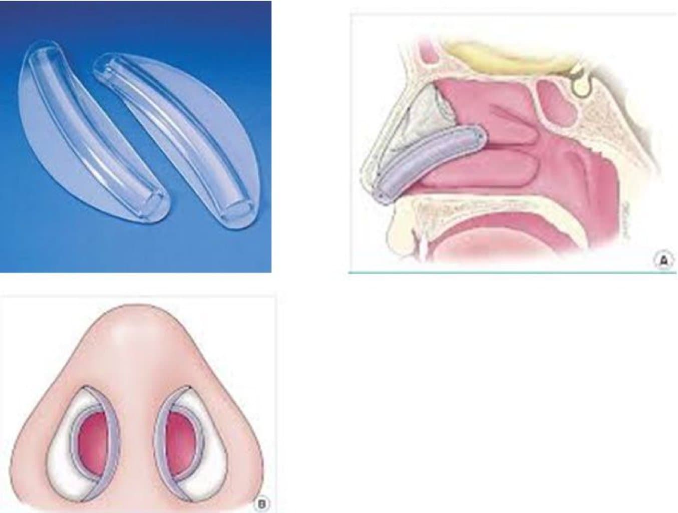 Septum-Concha Cərrahiyyə - Septoplastika