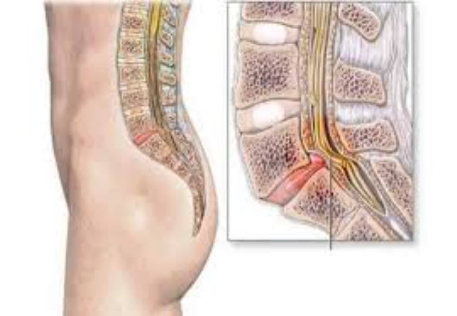 Osteoporoz xesteliyi