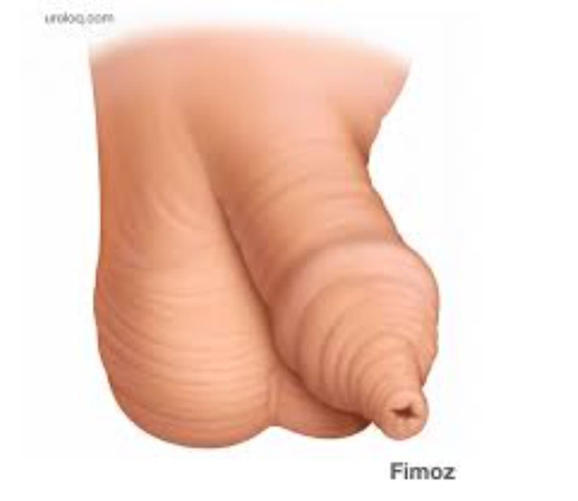 Fimoz (kənar pülüyün daralması)