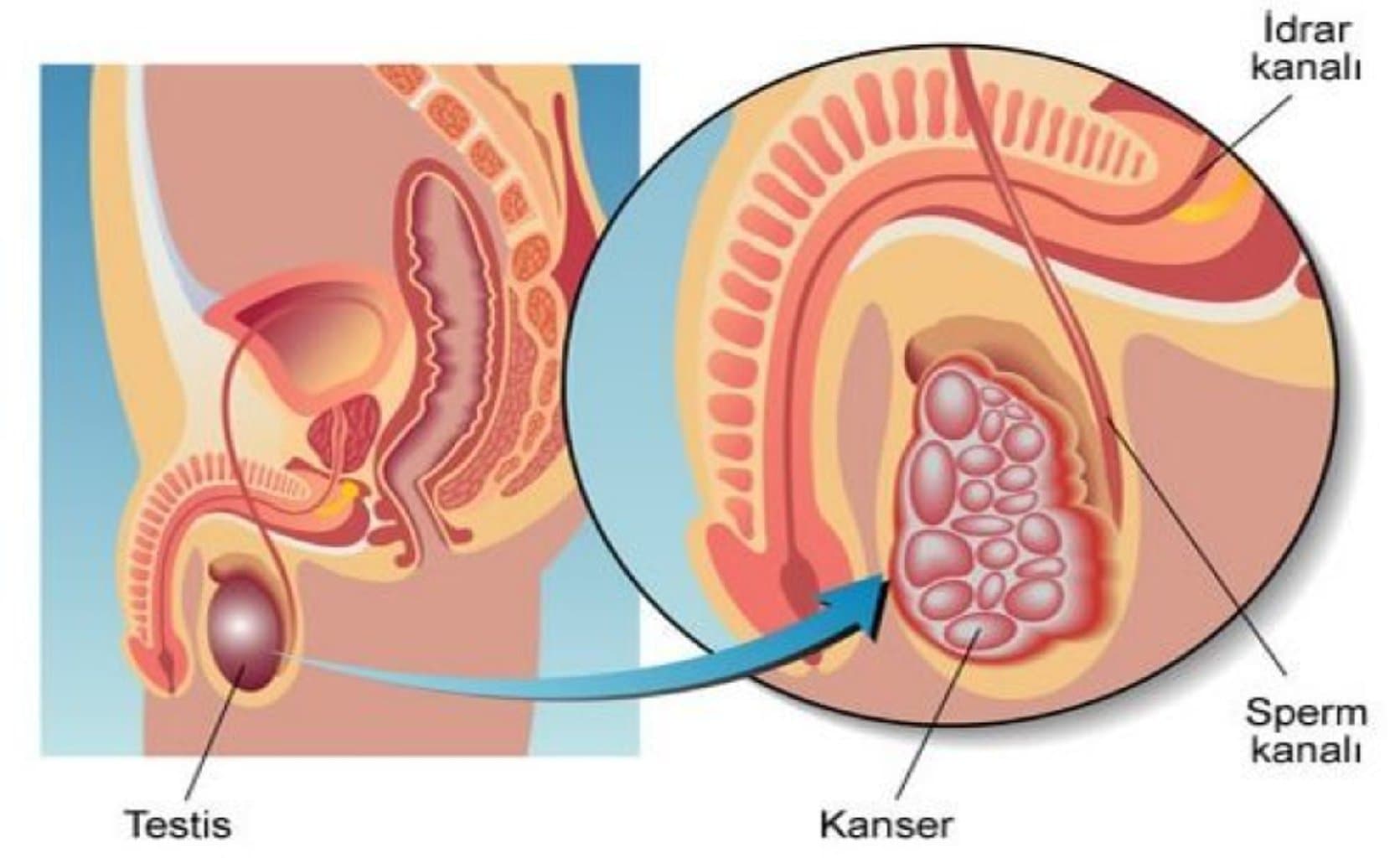 Testikulyar Xəstəliklər: Kişi Reproduktiv Sisteminin Sağlamlığına təsir edən şərtlər