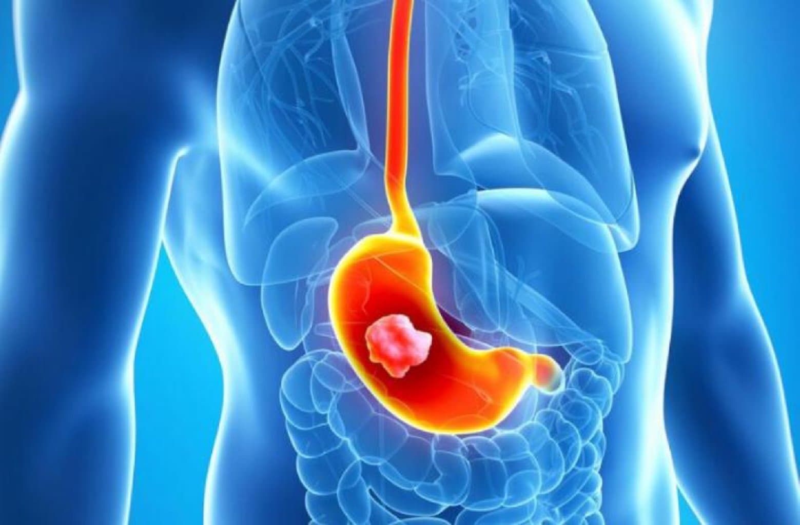 Mədə xərçəngi simptomlar