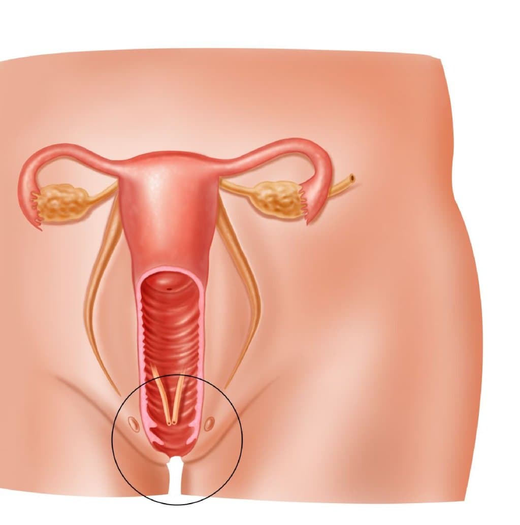 Sidik Kisəsinin Vaginaya Salınması və ya Sidik Kisəsinin Prolapsı (Sistosel)
