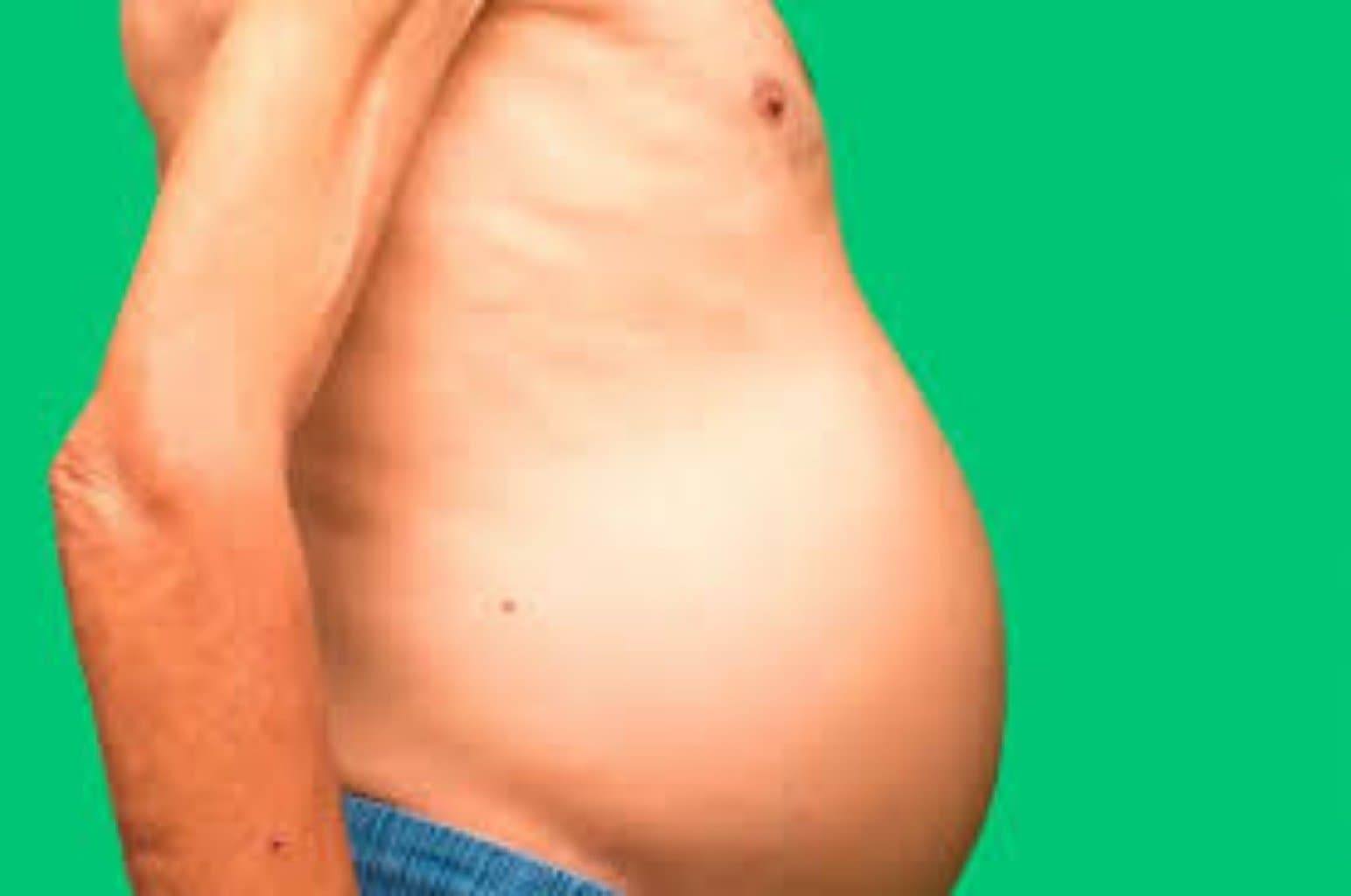 Qarında maye toplanması haqqda