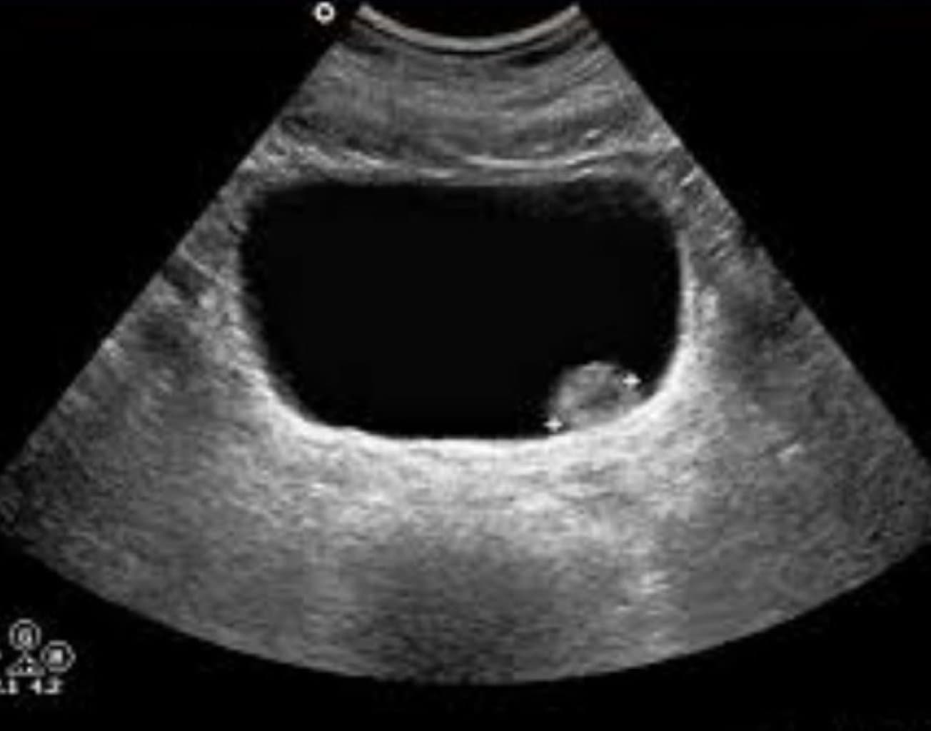 Sidik kisəsi xərçəngi
