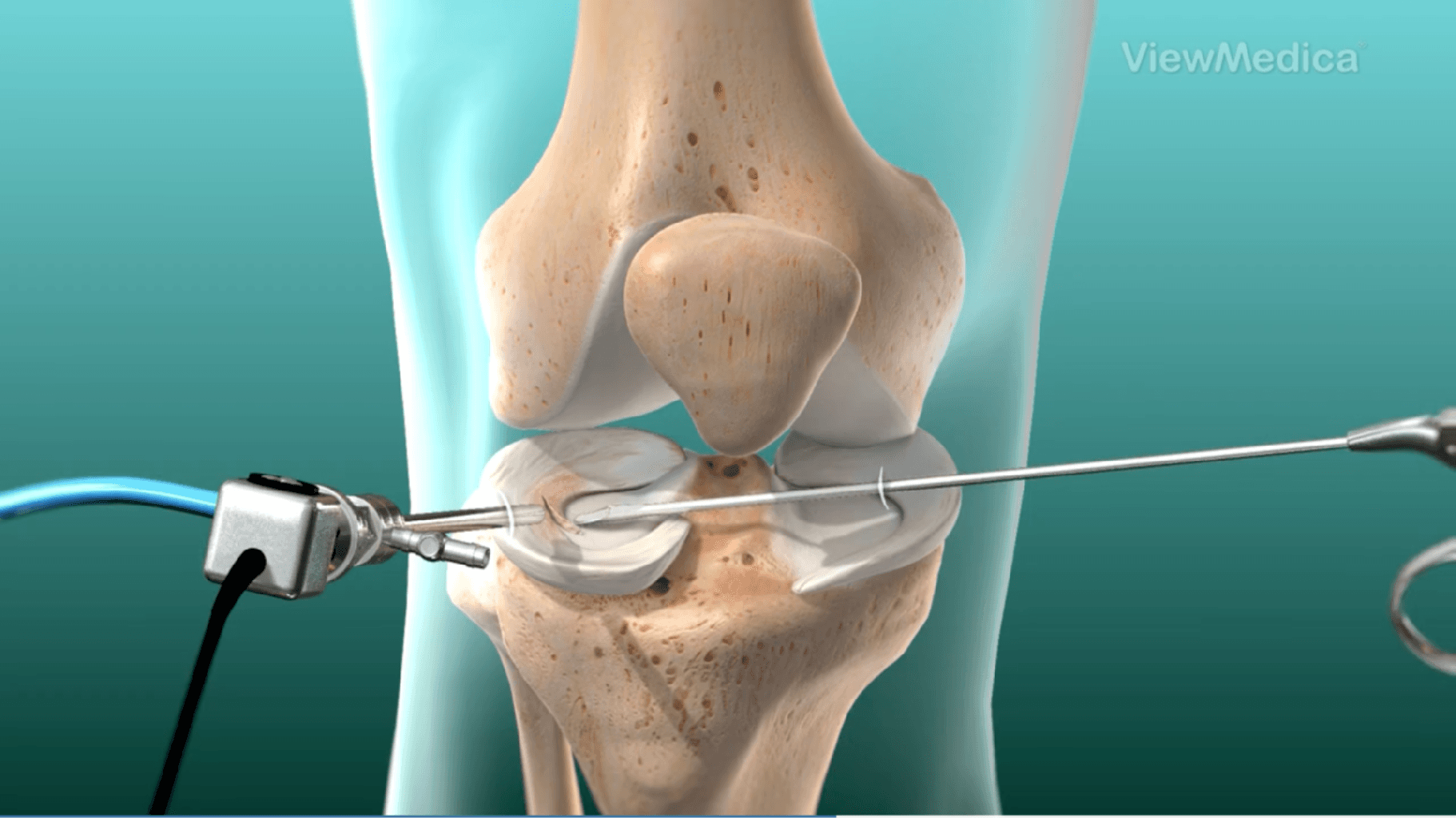 Menisektomiya: Diz Sağlamlığını bərpa edən Cərrahi Müdaxilə