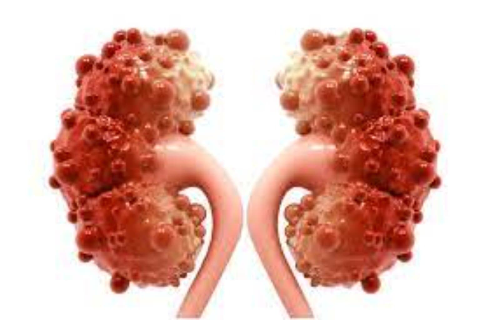 Böyrək kisti nədir? Müalicə edilməlidir?