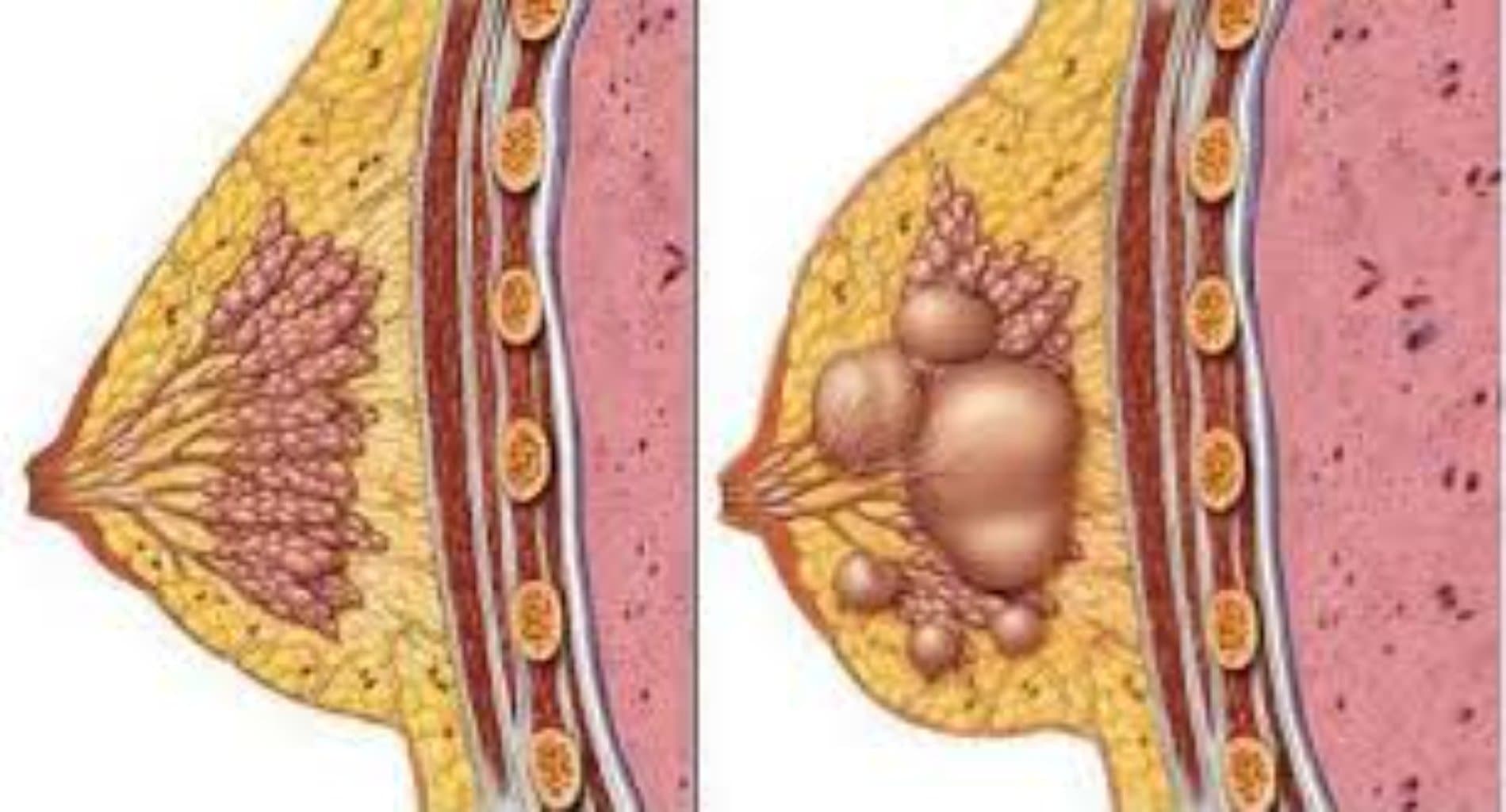 Süd Vəzi Xərçəngi: Simptomları, Səbəbləri və Müalicəsi
