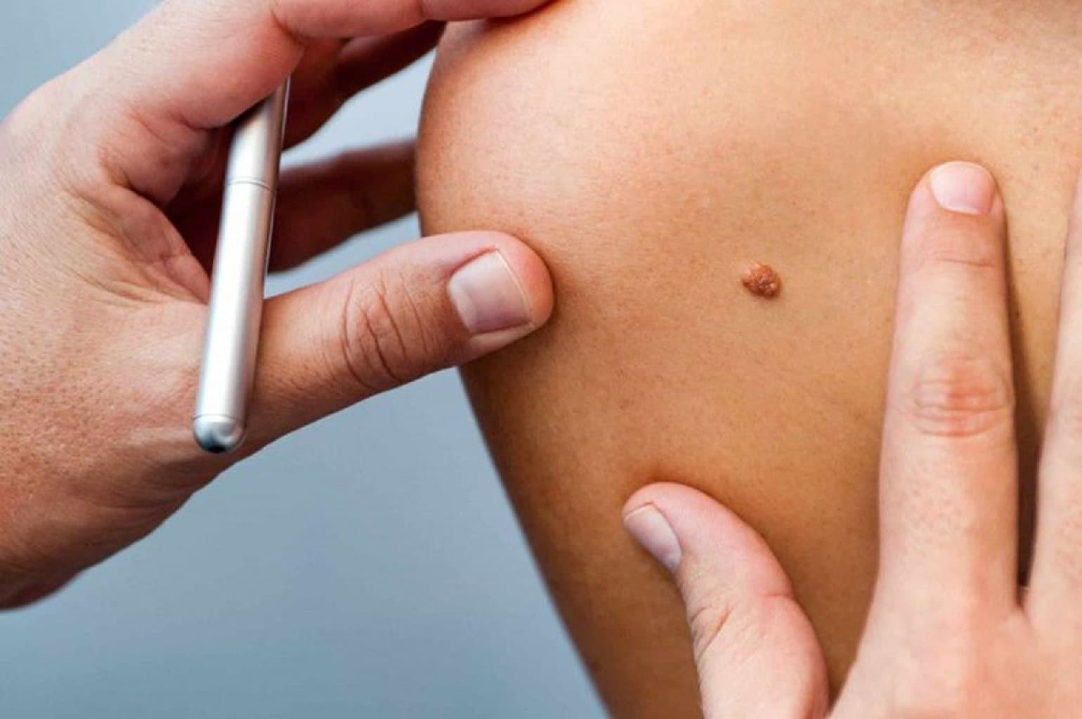 Dəri (Dəri) Xərçəng Əlamətləri, Müalicə və Qarşısının Alınması Metodları