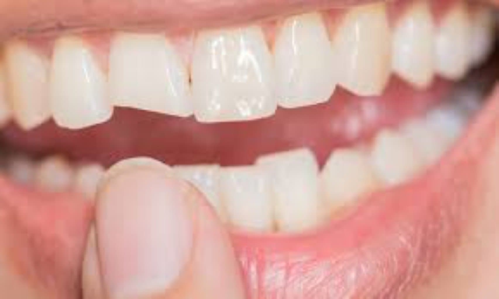 Diş itki və diş kəsilməsi