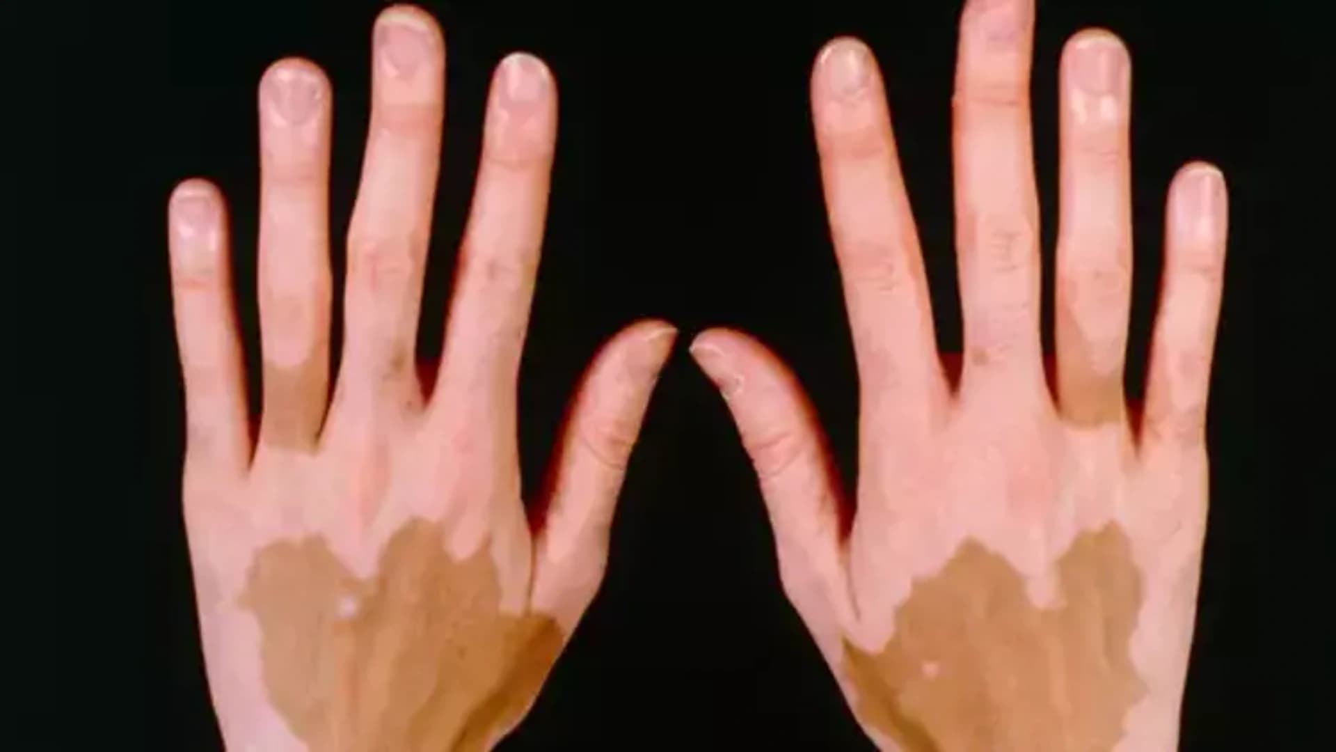 Kortizol hormon əksikliyi ( Addison Xəstəliyi )