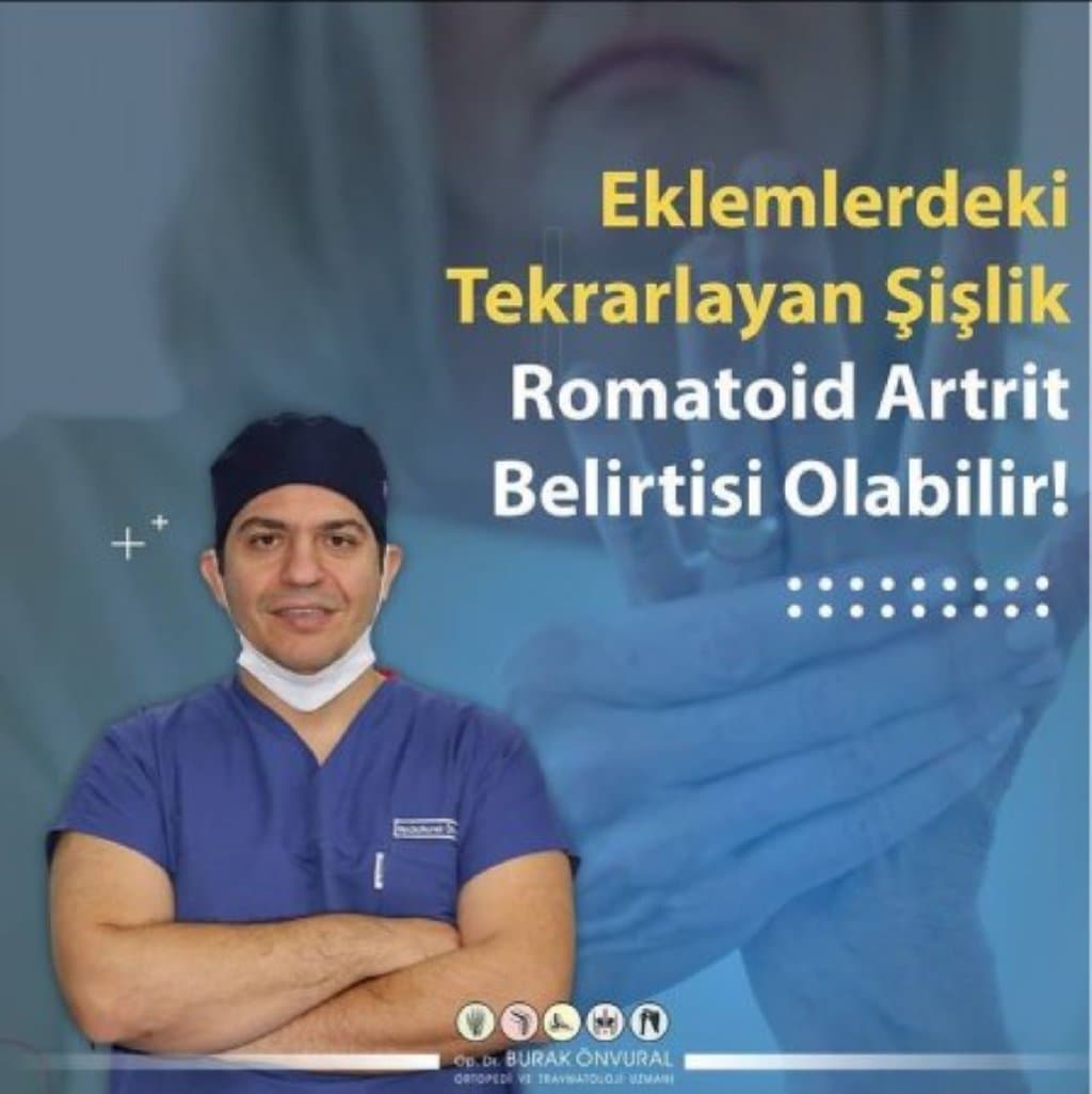 Oynaqlarda təkrarlanan şişlik romatoid artritin əlaməti ola bilər
