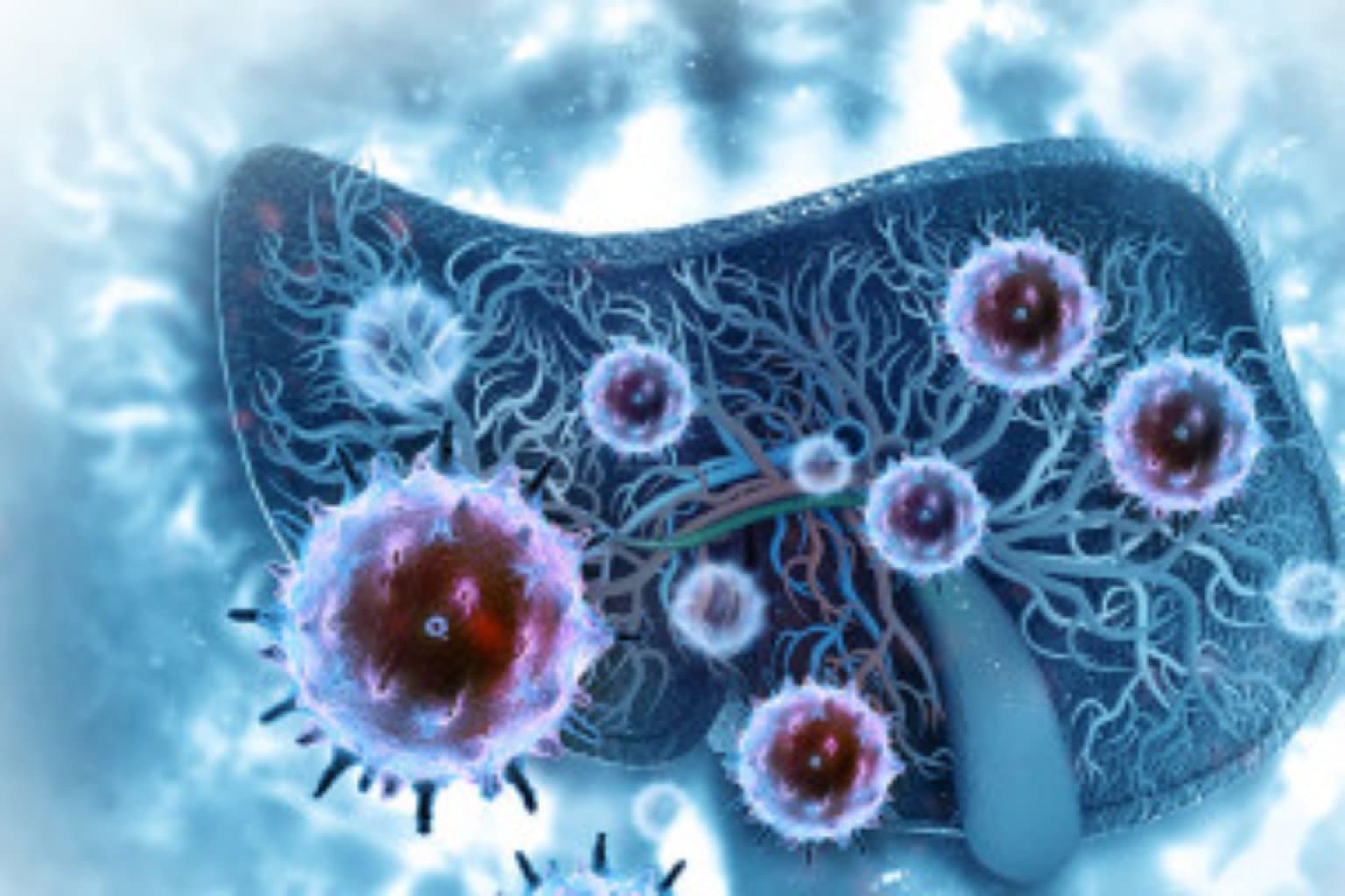 Qaraciyər Xərçəngi