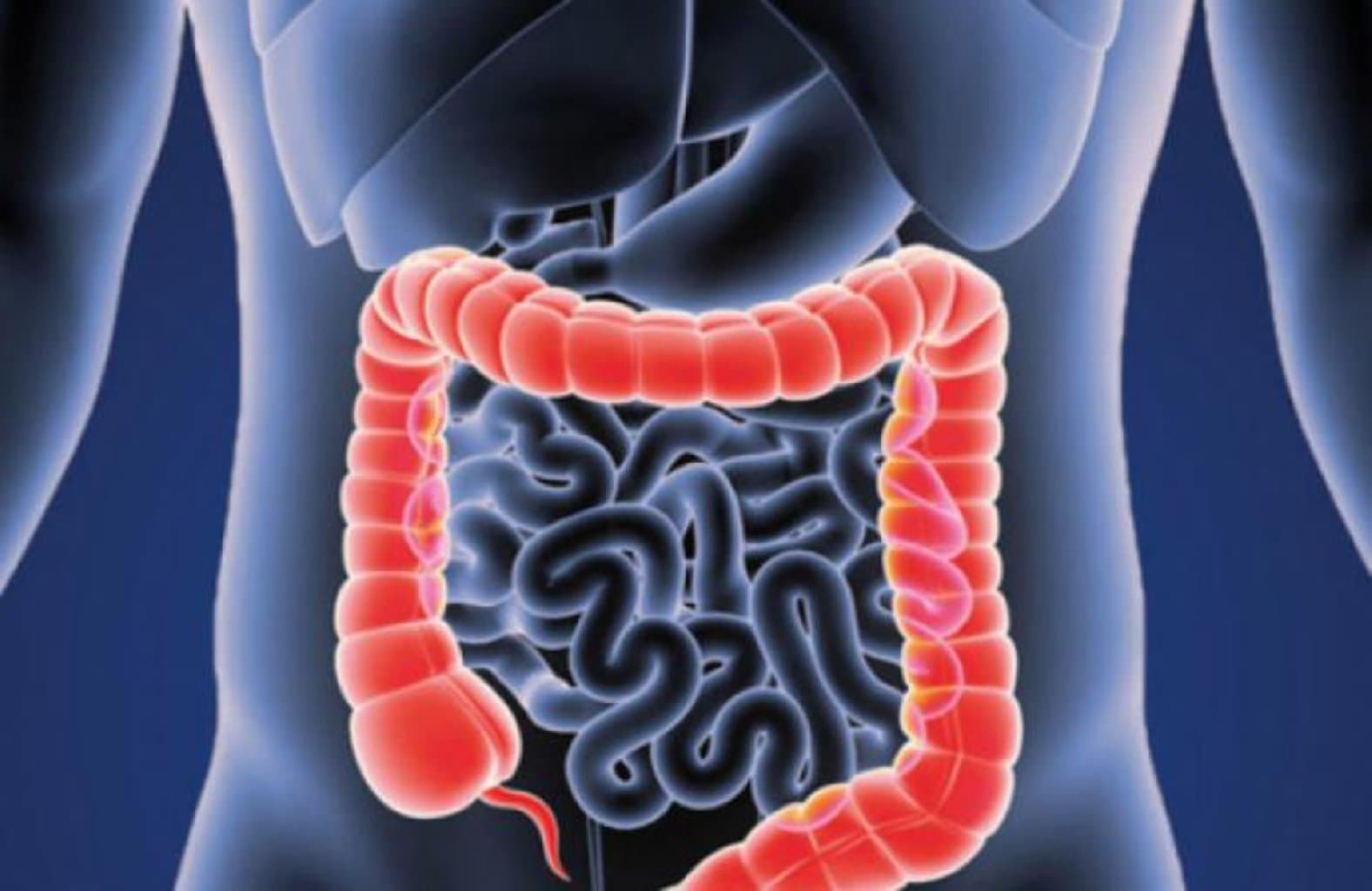 Bağırsaq keçməzliyi