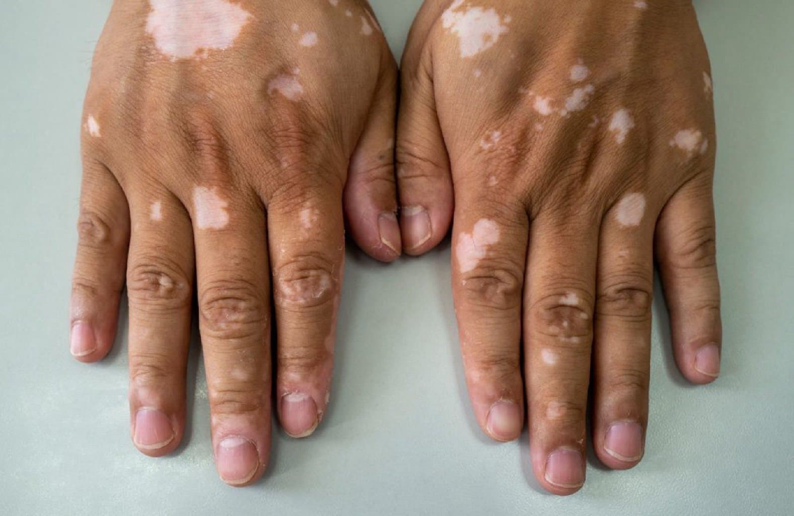 Vitiligo Xəstəliyi: Səbəbləri, Simptomları və Müalicə Yolları