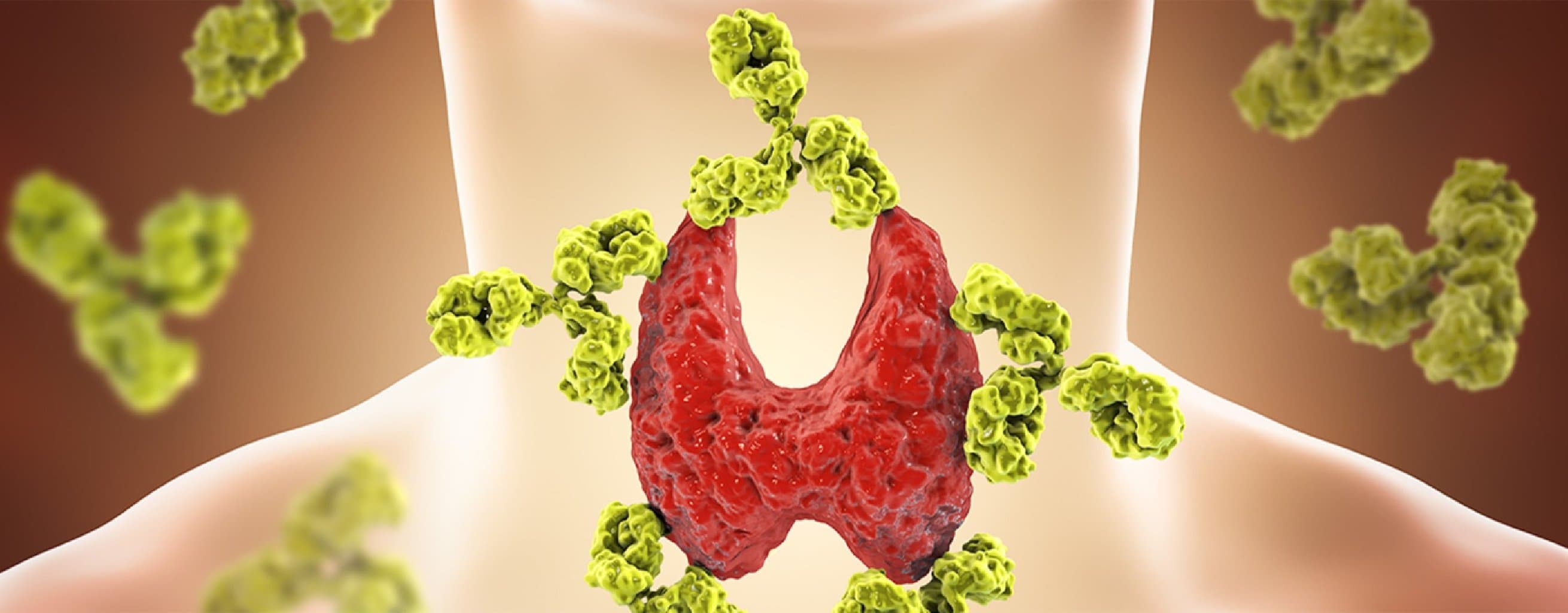 Haşimato tiroidi xəstəliyi nədir?