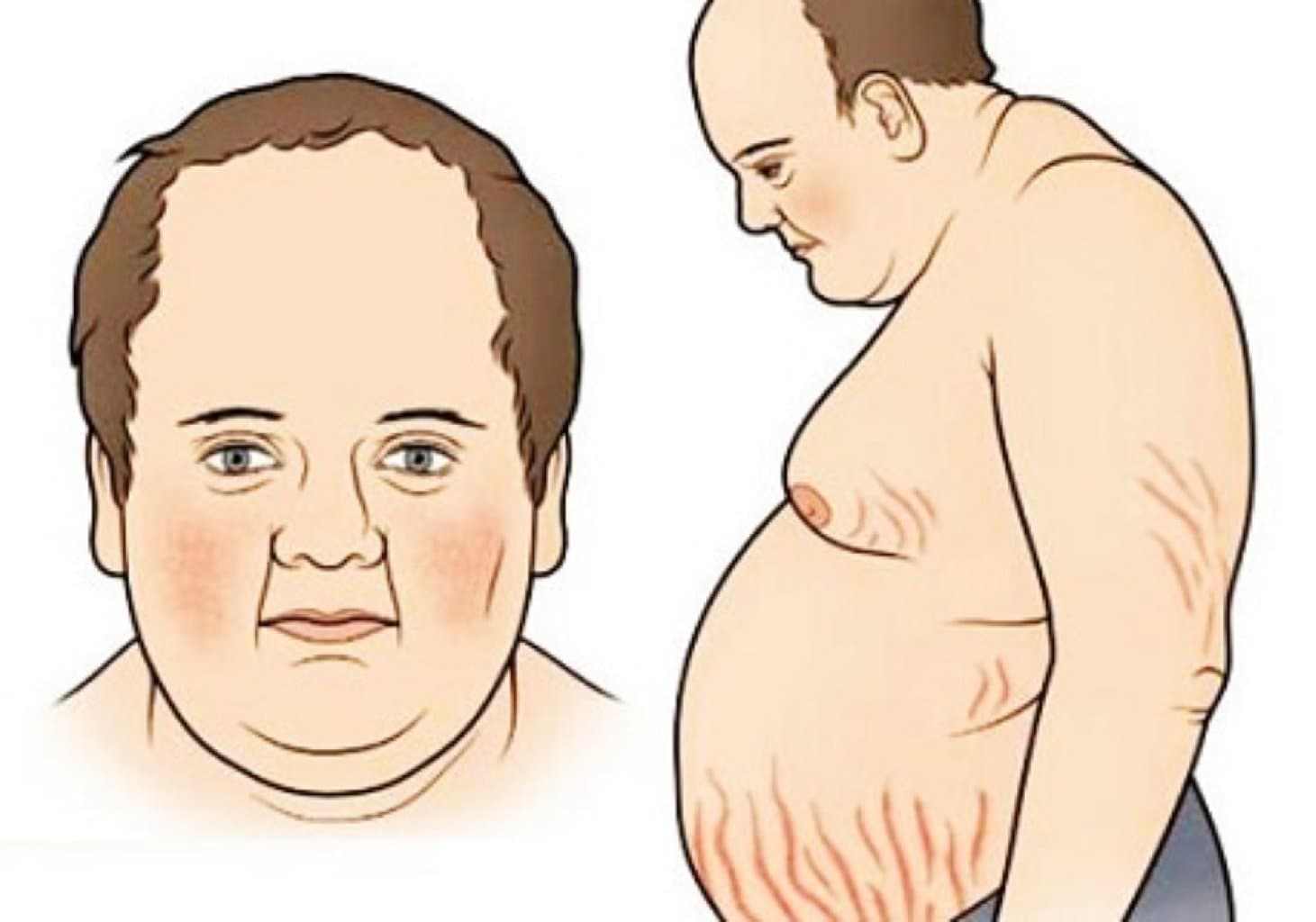 Kuşinq xəstəliyi (sindromu)