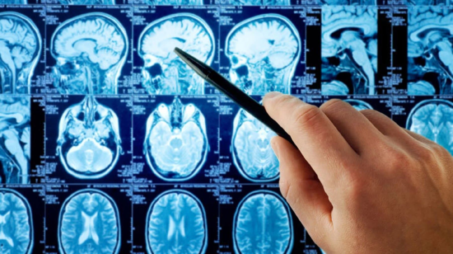 Beyin Travmalari: Səbəblər, Əlamətlər və Müalicə