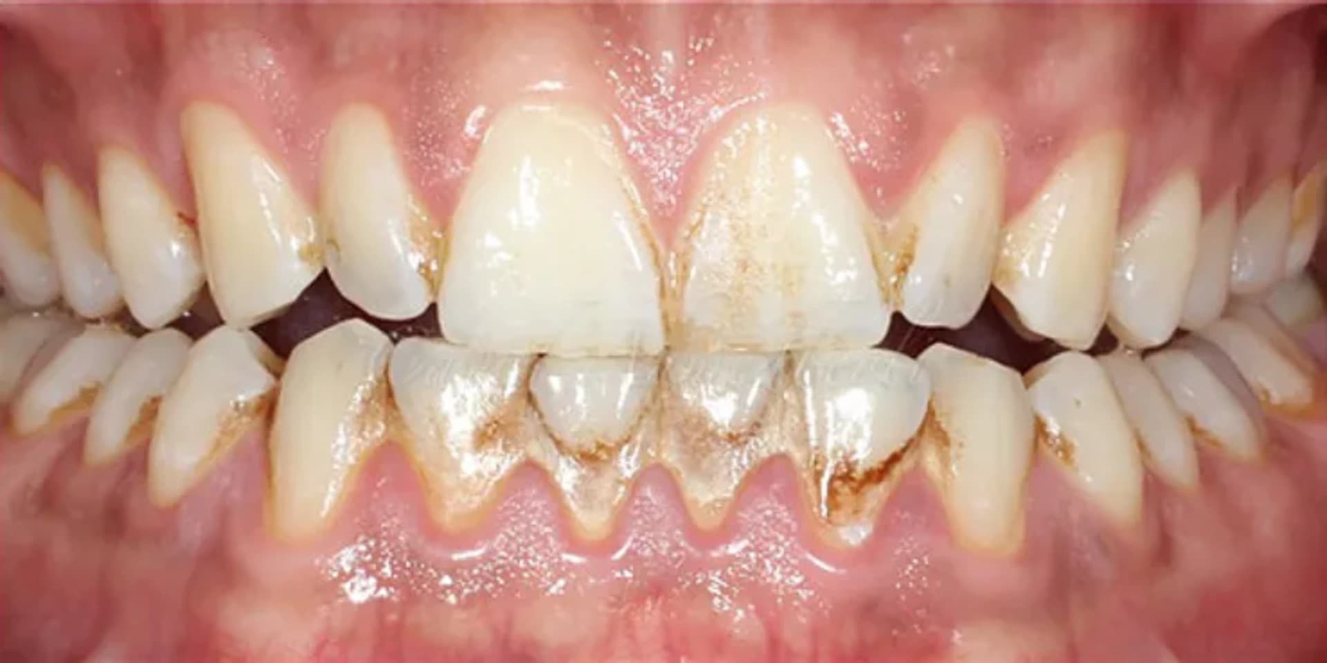 Diş Əti Xəstəlikləri: Gingivit və Periodontitdən Qorunma Yolları