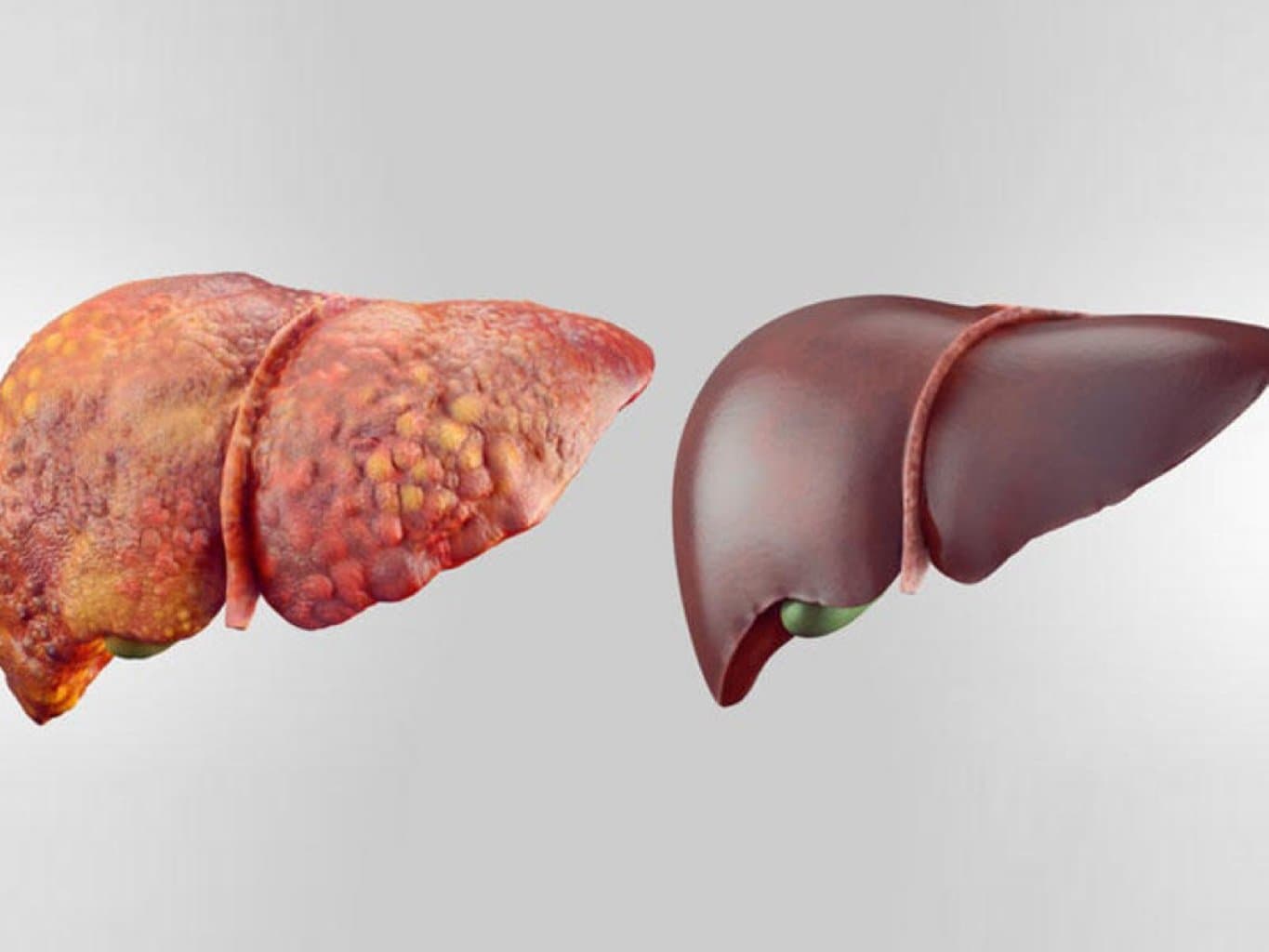 Qaraciyər çatışmazlığı