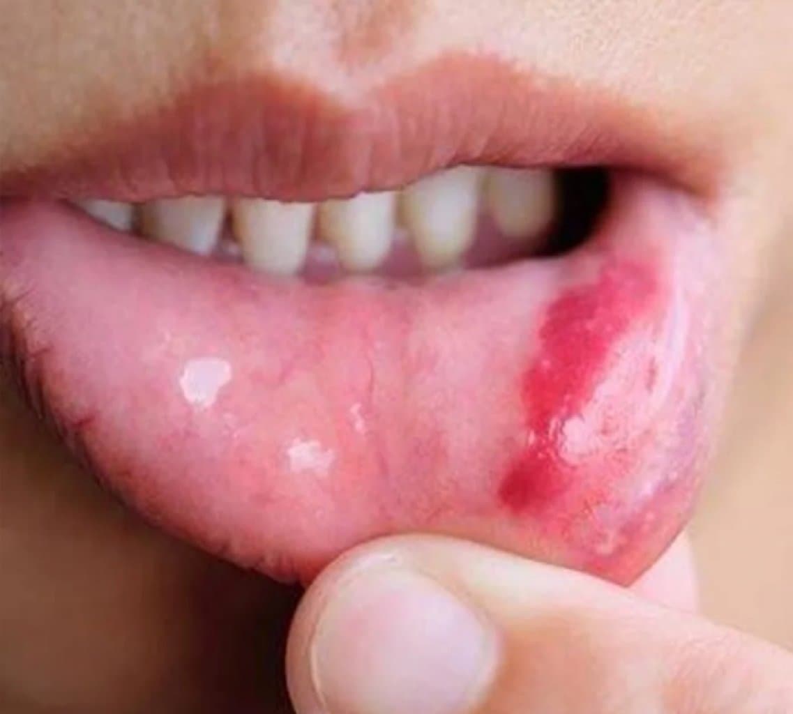 Ağız içi lezyonlar və ürəkçılğlar