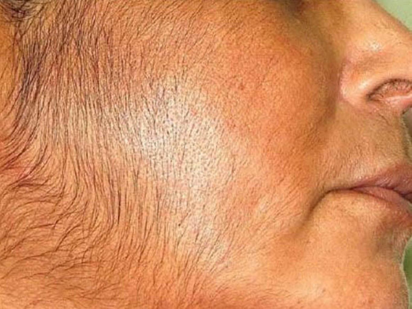 Qadınlarda tüklənmə