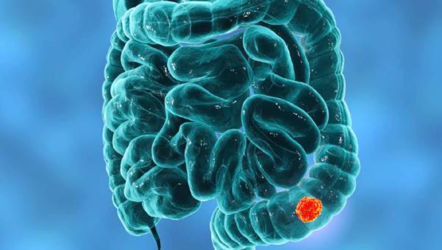 Kolon xərçəngi nədir?