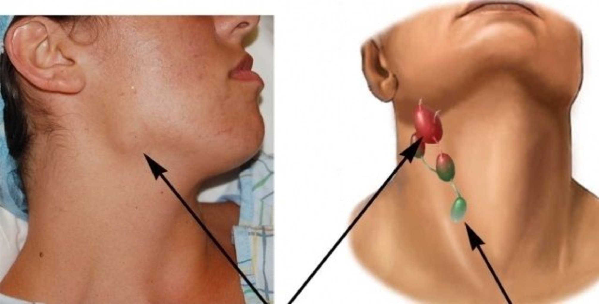 Limfa düyünləri nədir, onların quruluşu və böyüməsi