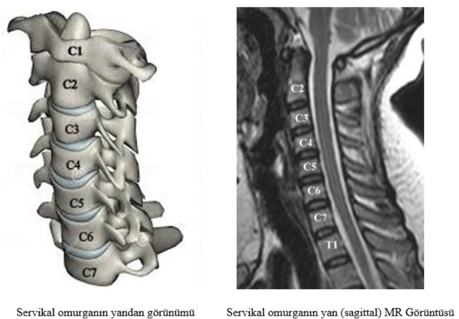 Servikal və Bel Disk Yırtığı: Səbəblər, Simptomlar və Müalicə Yolları