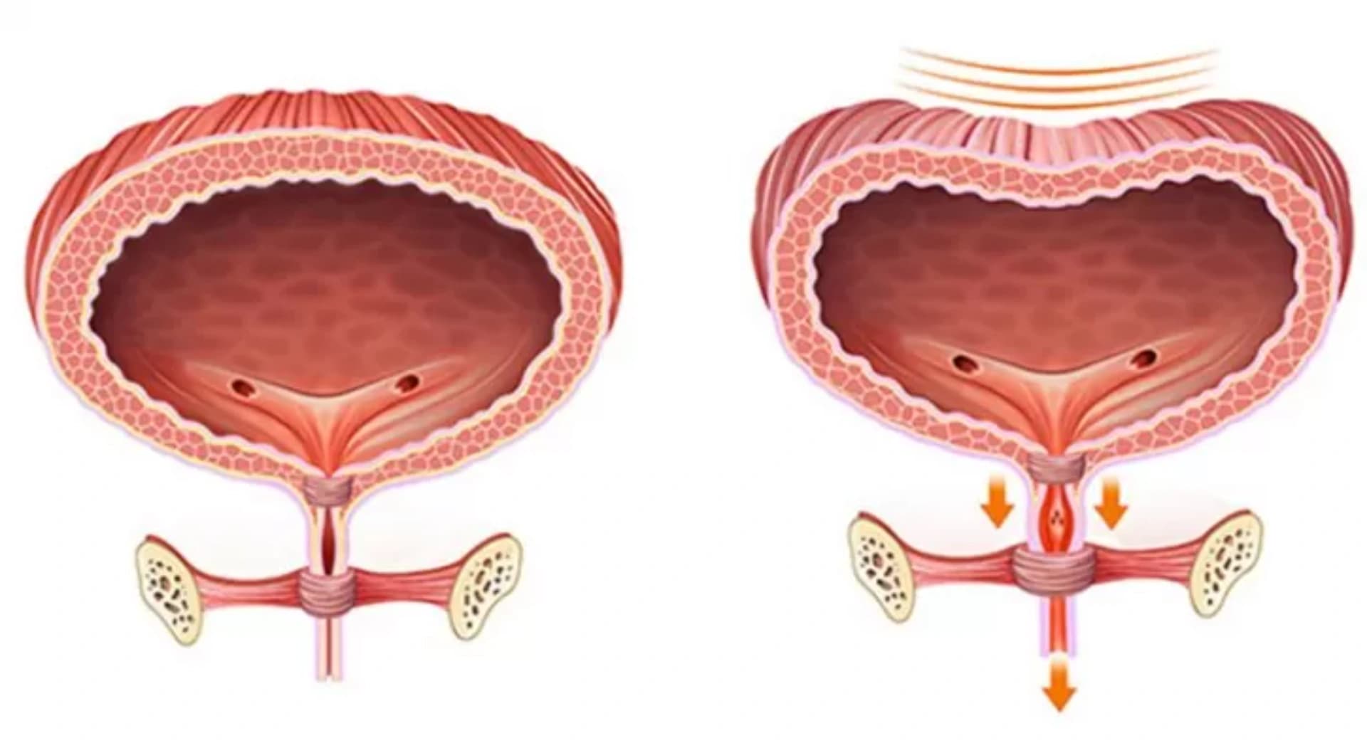 Həddindən artıq aktiv mesane sindromu: simptomlar, səbəblər və müalicələr