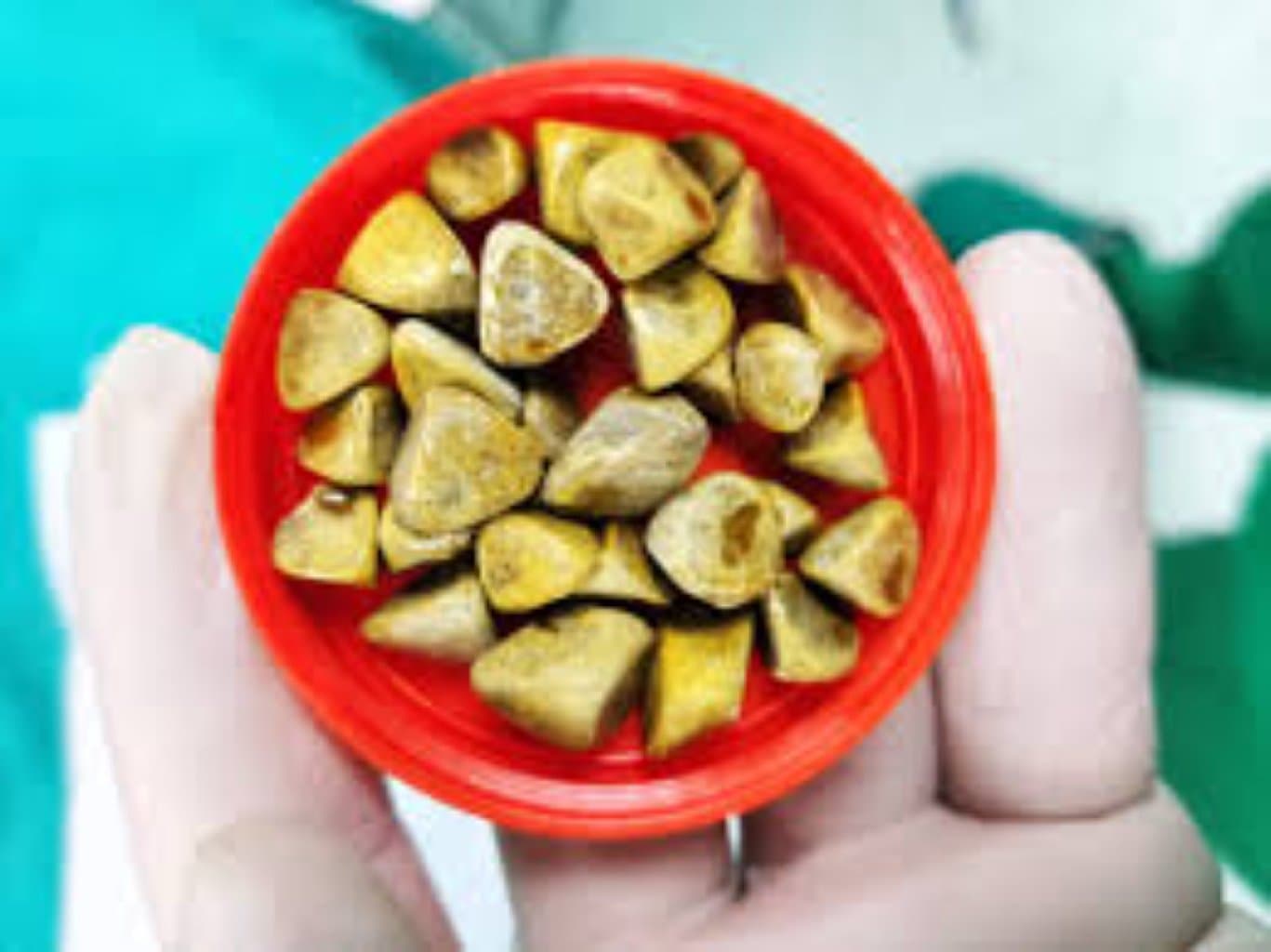 Öd kisəsi daşı: Diaqnoz və Müalicə Metodları