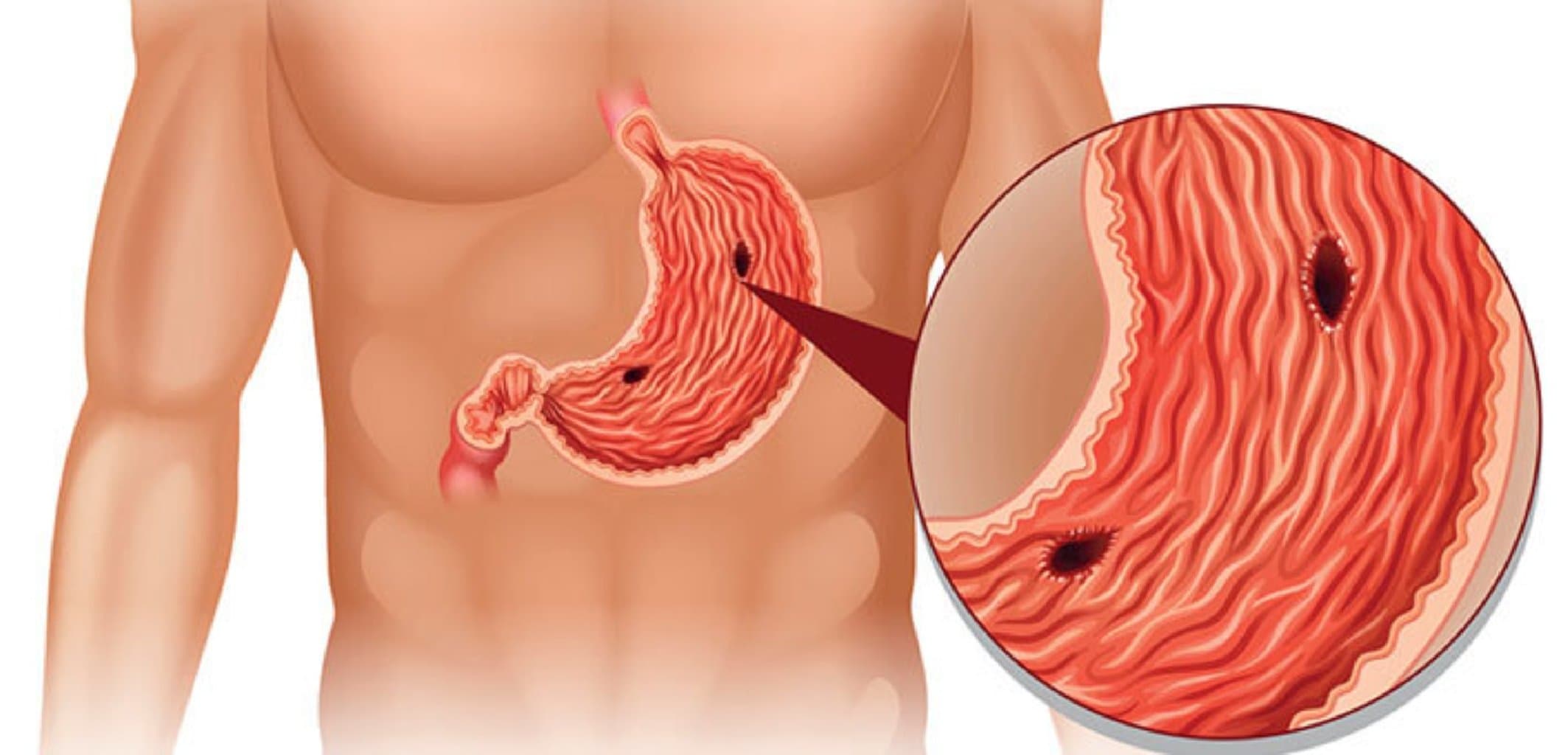 Mədə və 12-barmaq bağırsağın xora xəstəliyi