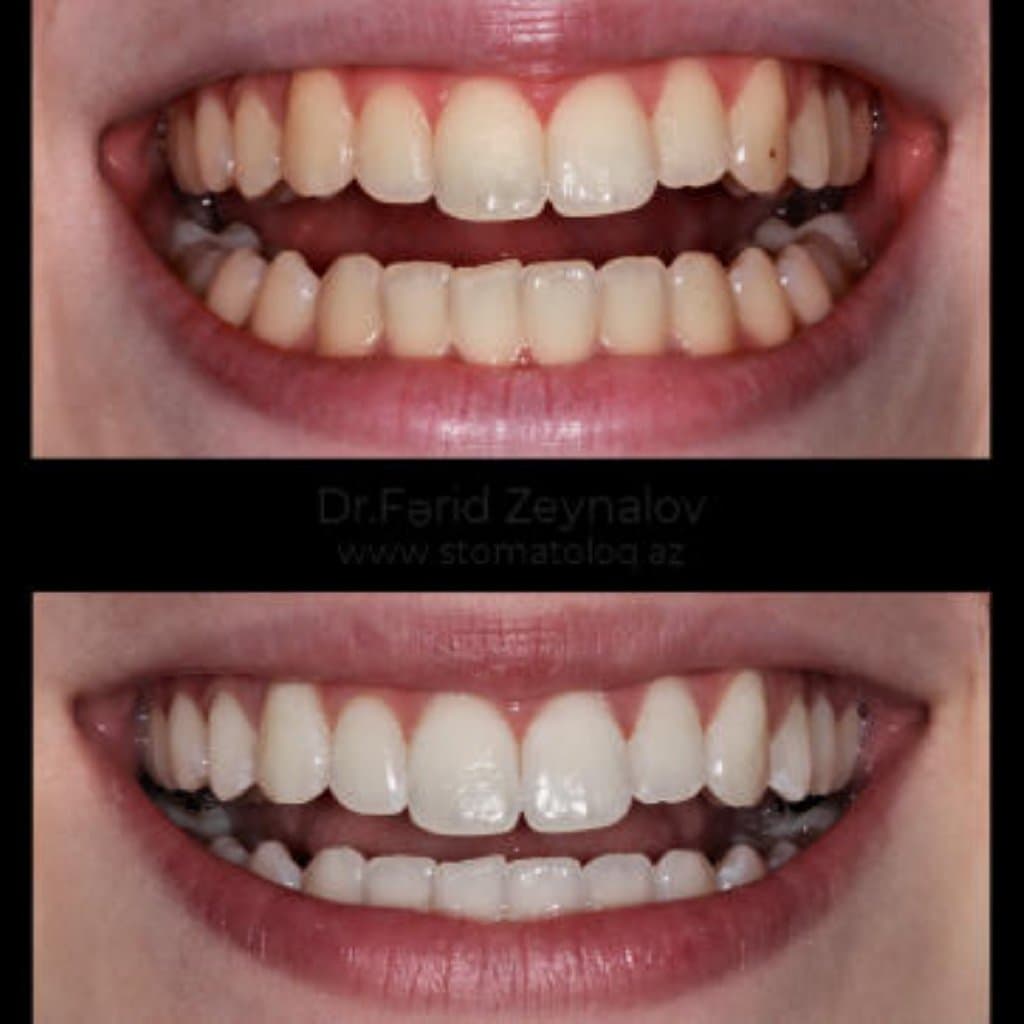 Dişlərin Ağardılması: Prosedur, Üstünlükləri və Diş Estetikasını Tərəqqi Et