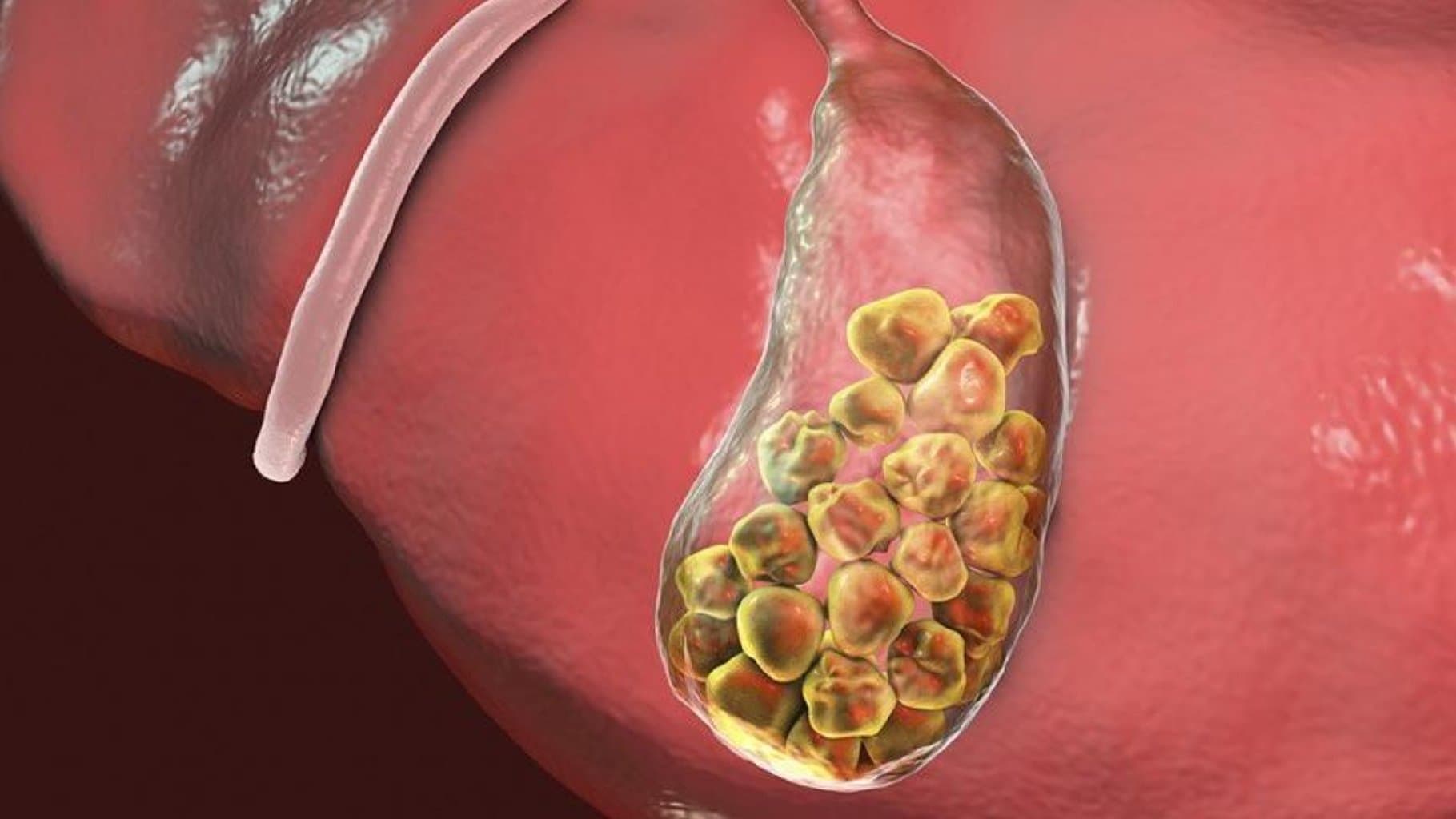 Öd kisəsi xəstəlikləri