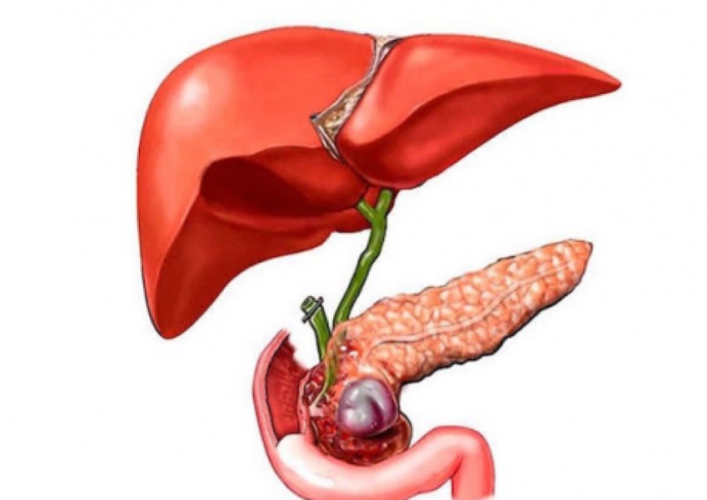 Akalkulyoz Xolesistit