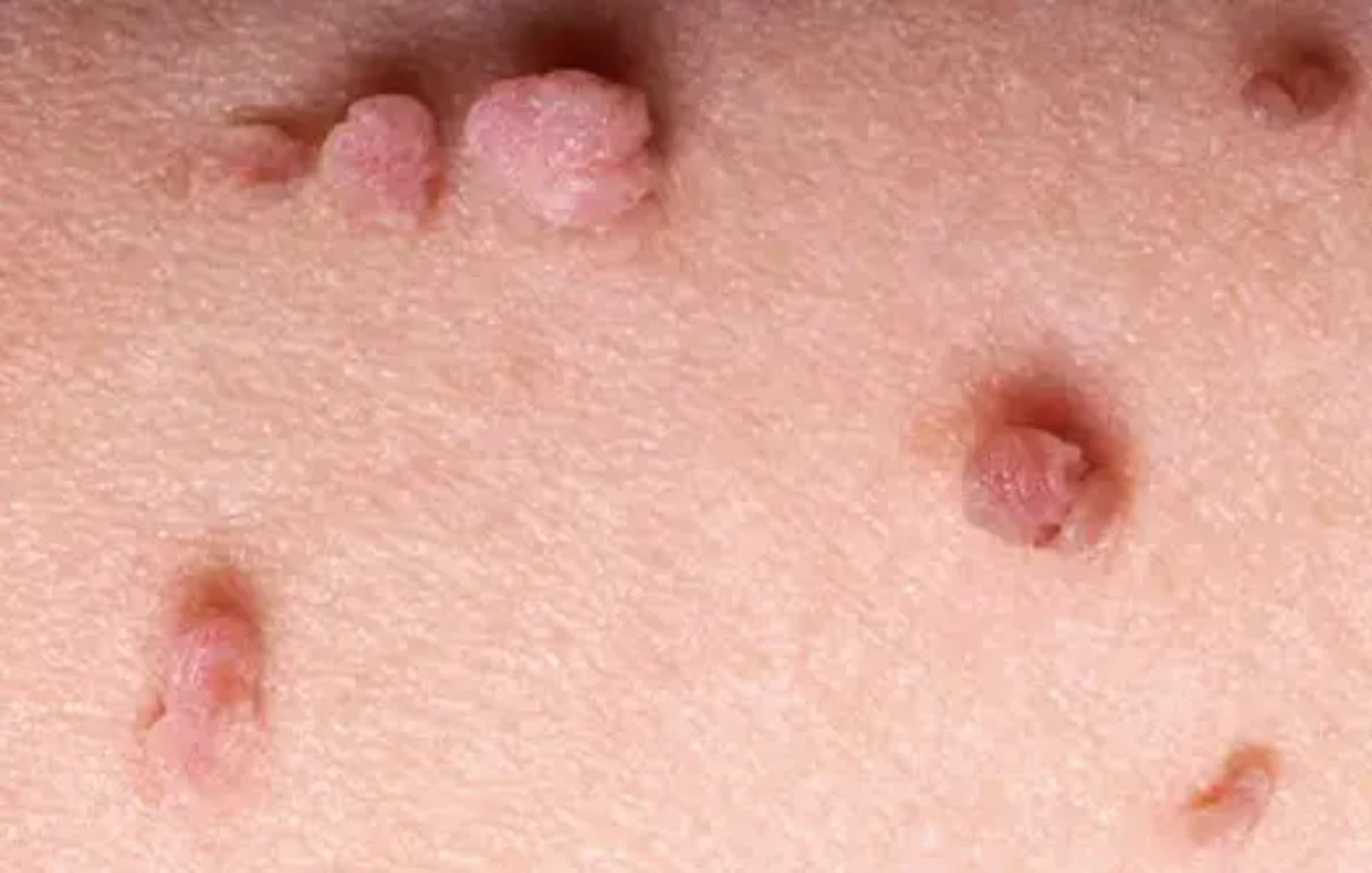 Genital Siğil (hpv) nədir?