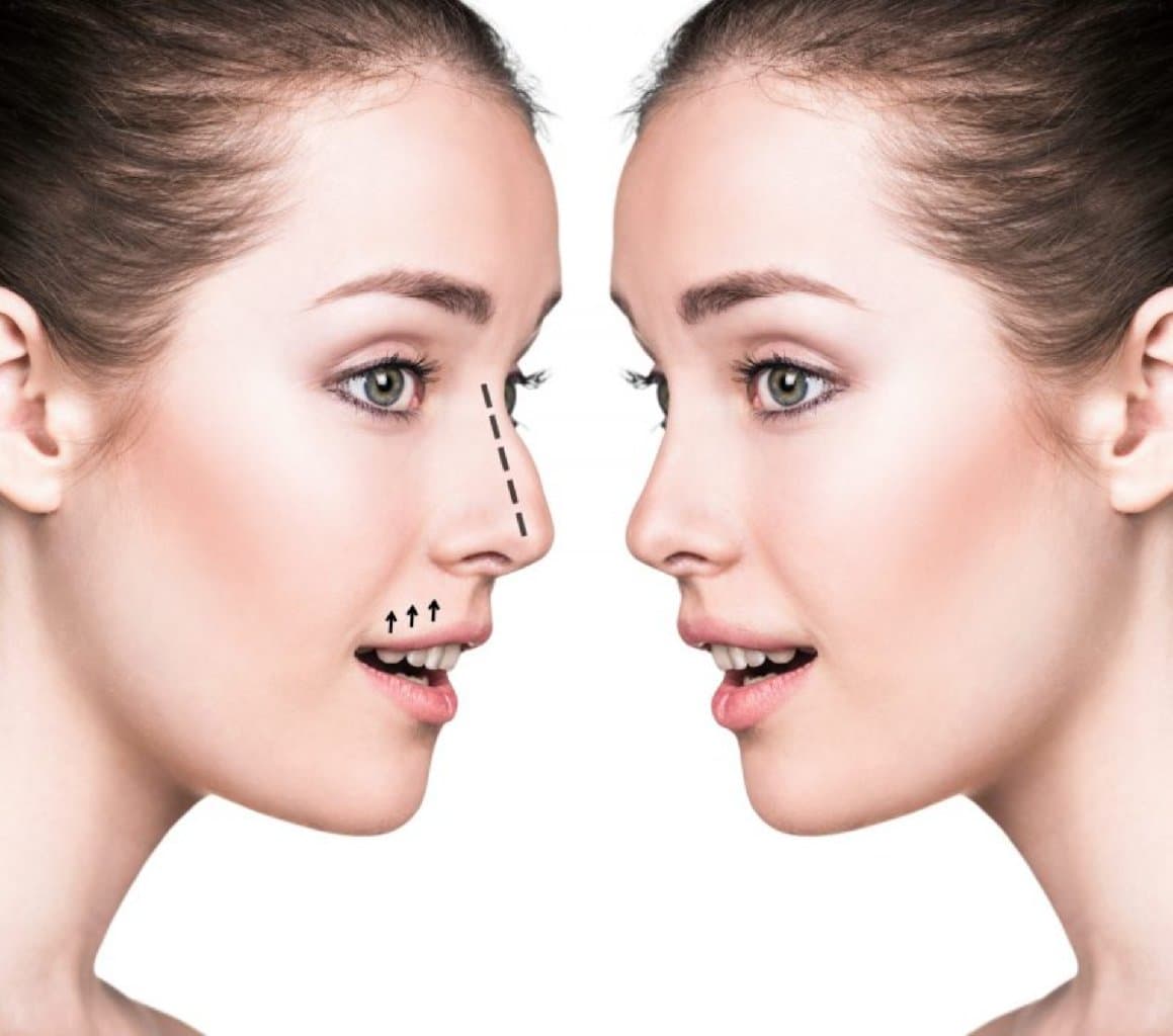 Adenoid-Tonsil Cərrahisi