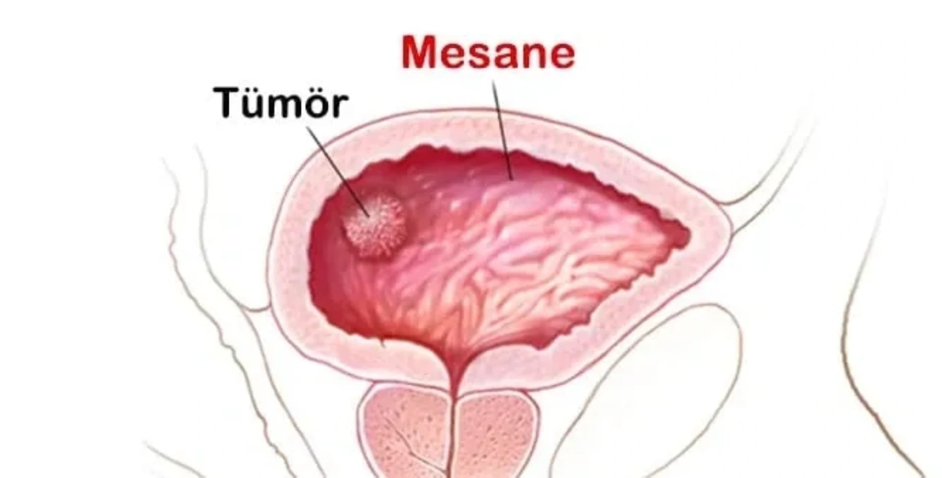 Sidik Kisəsi, Böyrək və Adrenal Vəzi Xərçəngləri: Ümumi Baxış