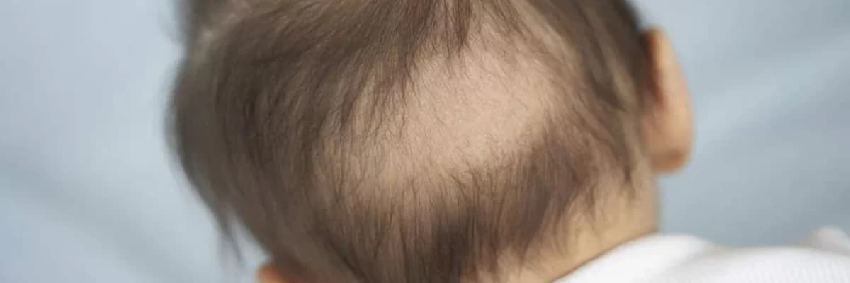 Saç və Saç Yolma Xəstəliyi