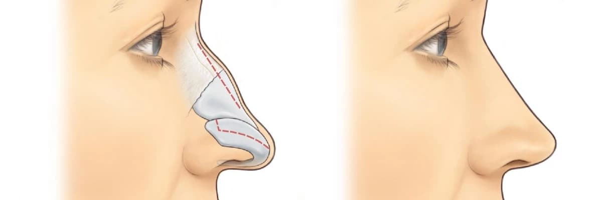 Burun Estetikası (Rinoplastika): Estetik və Funksional Cərrahi Müdaxilə