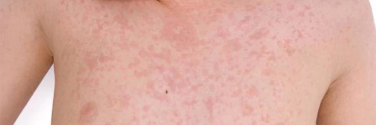 Övrə və övrəyəbənzər səpkilərin differensiyası