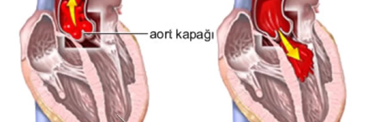 Aorta Çatışmazlığı: Qapaq Ürək Xəstəliyinin Mühüm Forması