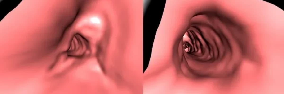 Nəfəs borusunun daralması əməliyyatı