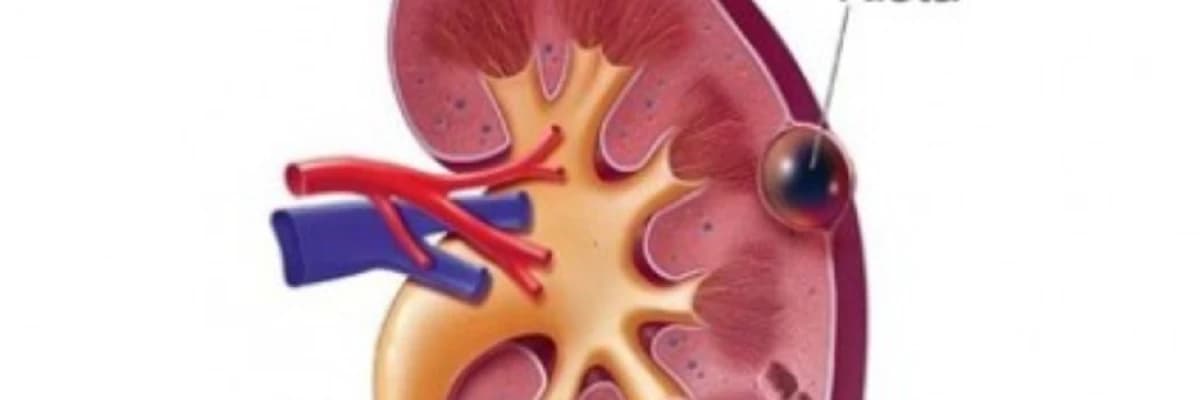 Böyrək kistaları nədir? Müalicə üsulları