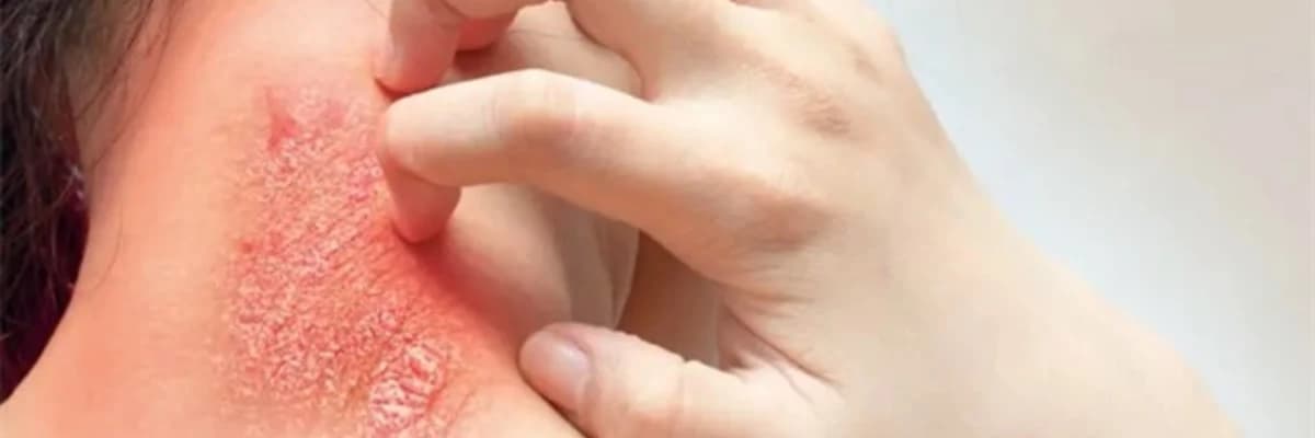 Mantar dəri infeksiyası: simptomlar, müalicə və qarşısının alınması Sağlamlıq Bələdçisi