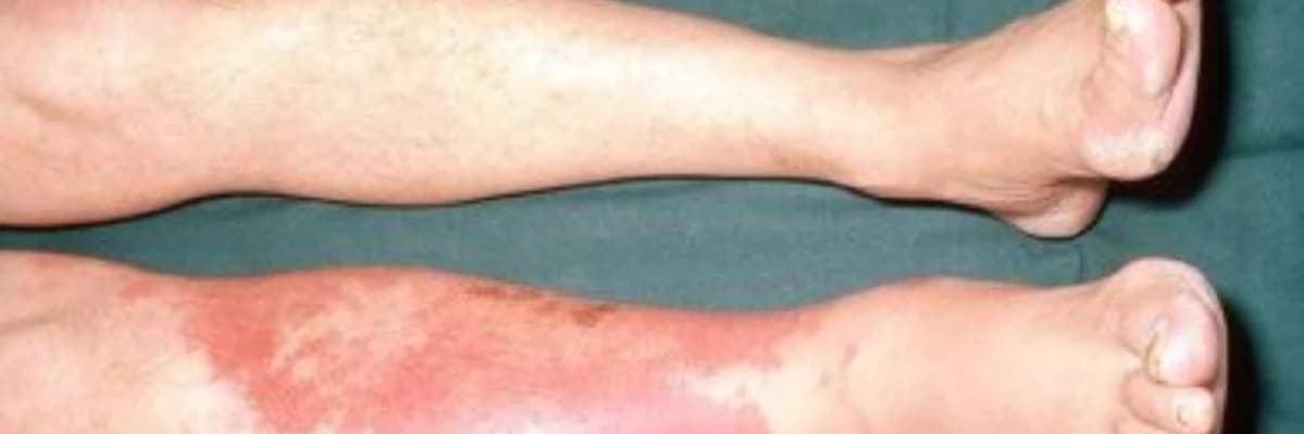 Qızılyel xəstəliyi (Erysipelas)