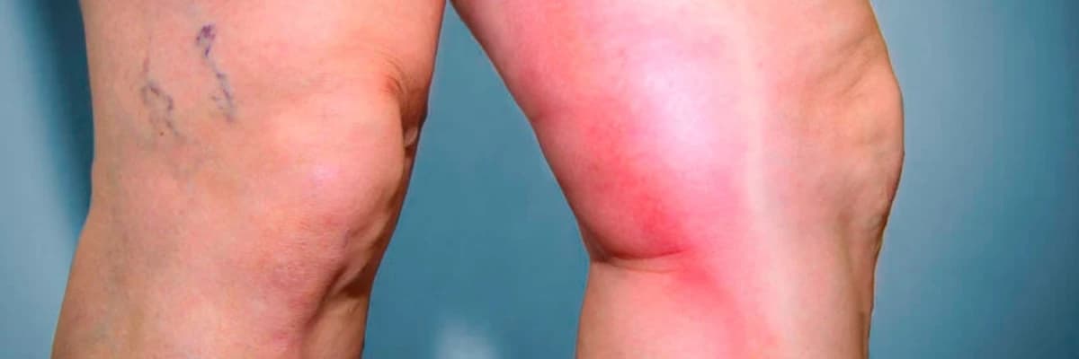 Aort Xəstəlikləri