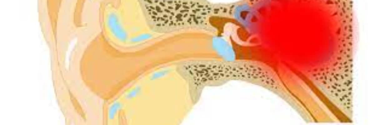 Kəskin və xroniki orta otit