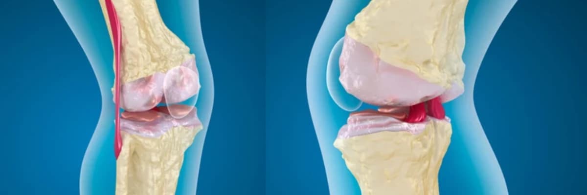 Osteoartrit nədir və necə təsir edir?