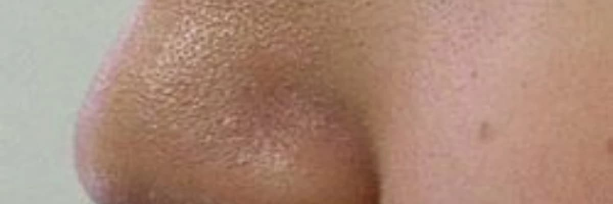 Burun Əməliyyatından Sonra Dərinin Yağlanması