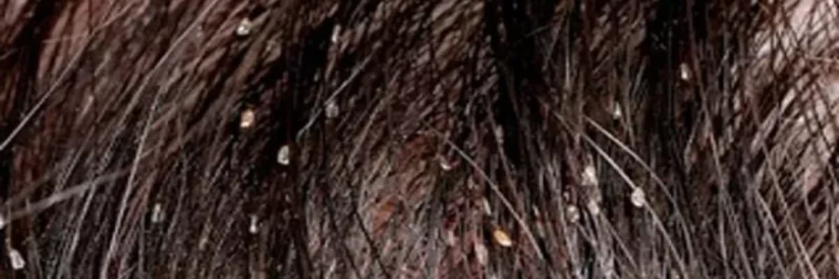 Baş biti: səbəbləri, simptomları və müalicə üsulları